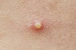 祛疣資訊，開啟疣的告別之旅